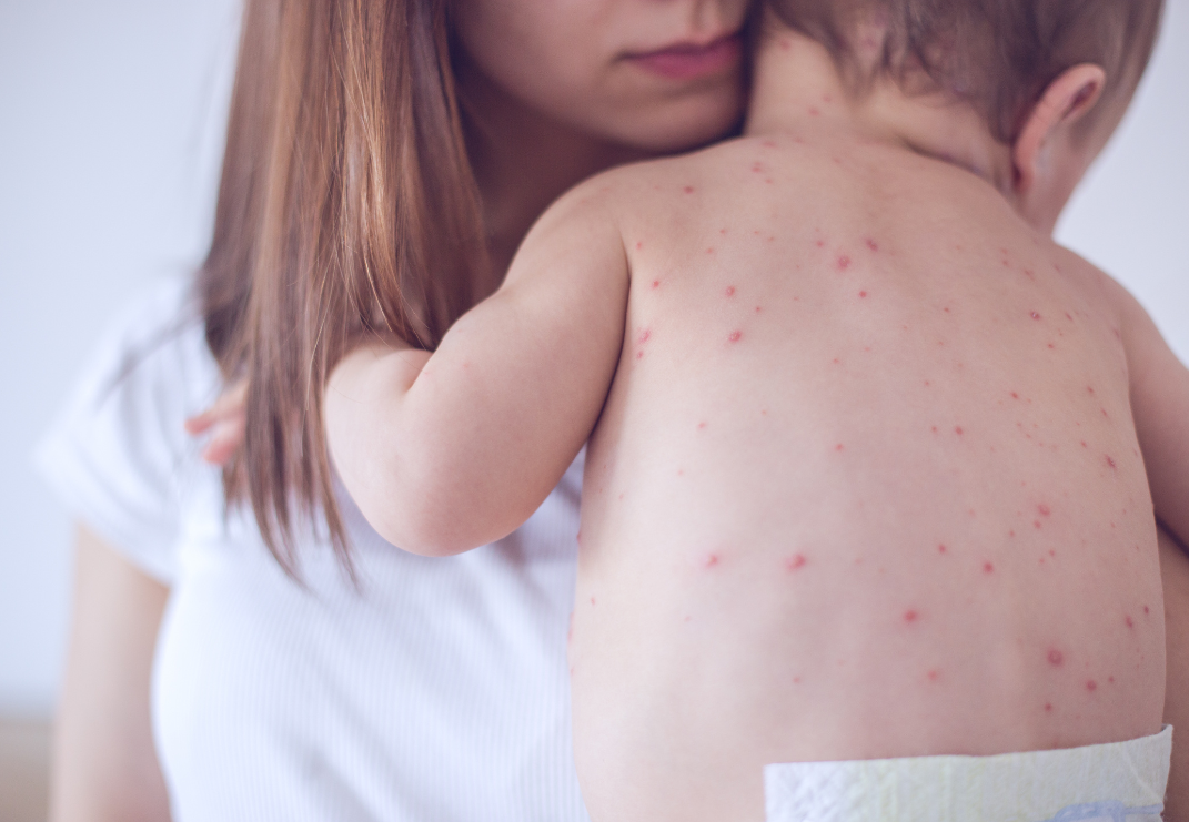 Measles Uptick In 16 States Has Health Officials Raising The Alarm. What You Need To Know.